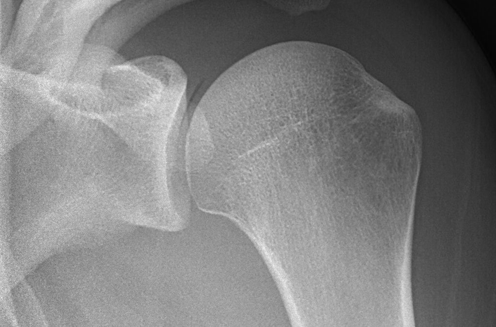 Cas clinique n°2 : douleur et tendinite calcifiante de l’épaule.